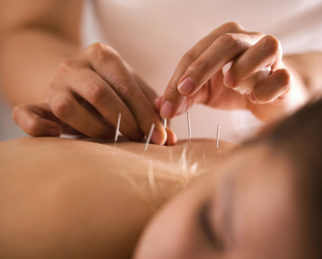 Deep needling sm