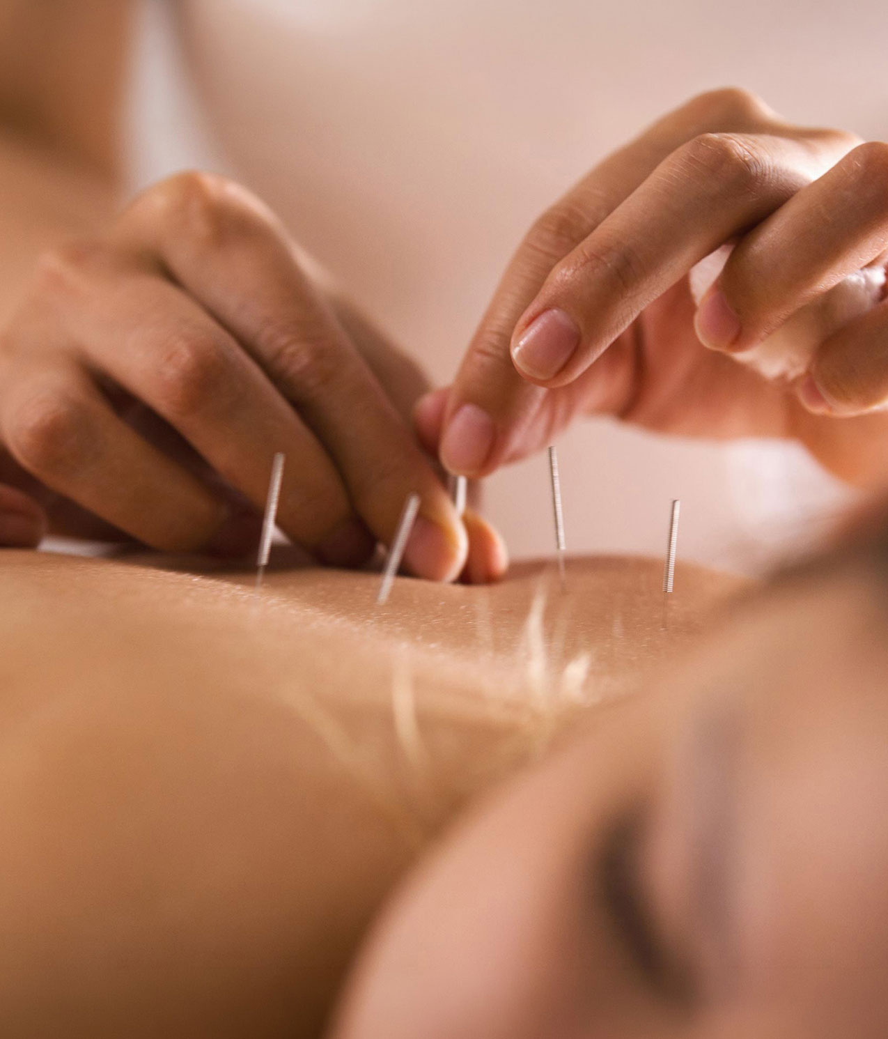 Deep needling