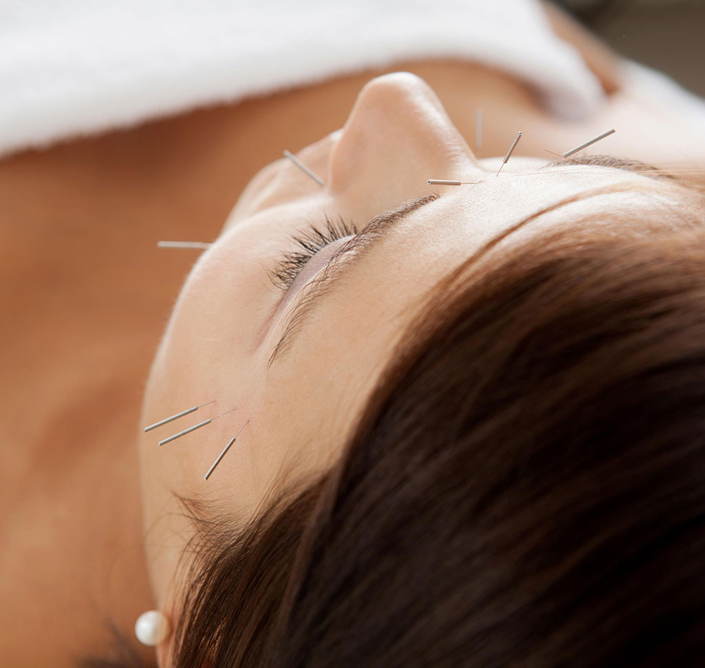 Facial acupunture